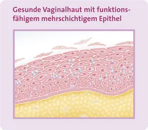 Abbildung der gesunden Vaginalhaut