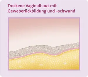 Abbildung trockene Vaginalhaut mit Geweberückbildung und -schwund